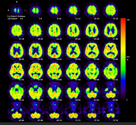 脳血流シンチグラム