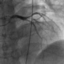 心臓の血管（左冠動脈）