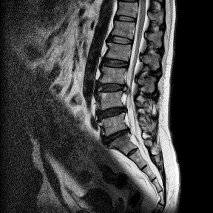 腰椎縦断面画像