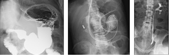 胃透視/イレウス管挿入/尿管造影