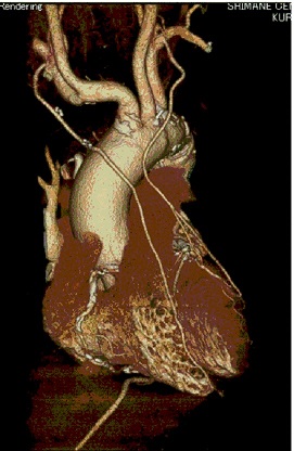 左右内胸動脈と右胃大網動脈を用いた冠動脈3枝バイパス