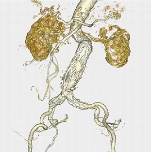 腹大動脈ステントグラフト内挿術　(術後)